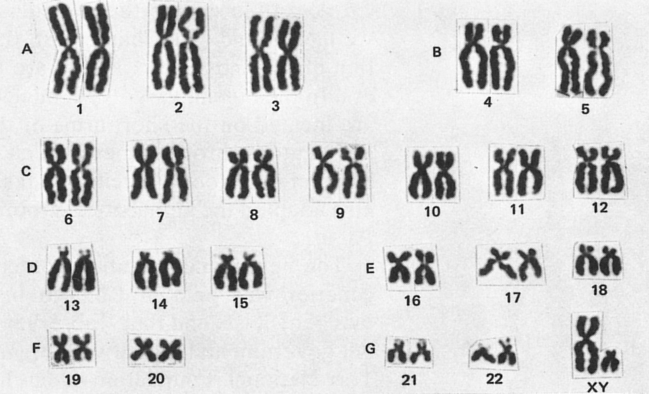 ELI5 What s The Relationship Between A Chromosome we Have 23 And A Gene R explainlikeimfive ELI5 What s The Relationship Between A Chromosome we Have 23 And A Gene R explainlikeimfive