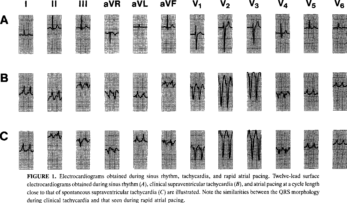 PDF Atriofascicular Connection Or A Nodoventricular Mahaim Fiber Electrophysiologic Elucidation Of The Pathway And Associated Reentrant Circuit Semantic Scholar PDF Atriofascicular Connection Or A Nodoventricular Mahaim Fiber Electrophysiologic Elucidation Of The Pathway And Associated Reentrant Circuit Semantic Scholar